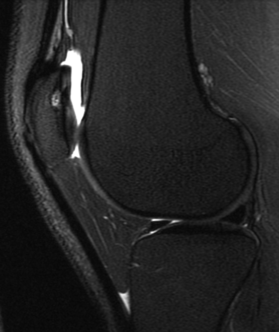 UW_MSKrad's tweet photo. #CaseOfTheWeek ‼️🎉‼️

☢️🩻☠️Case #13☠️🩻☢️
 
Another knee coming your way! 
#KneePain🦴🩻🤕

➡️➡️➡️Diagnosis❓🧐🔍🧩

#MSKRad #FOAMrad #radres #MedEd #RadEd #OrthoTwitter #SportsOrtho @ssr_rwg @UWRadRes @AOSSM_SportsMed https://t.co/MPucHPzFPb