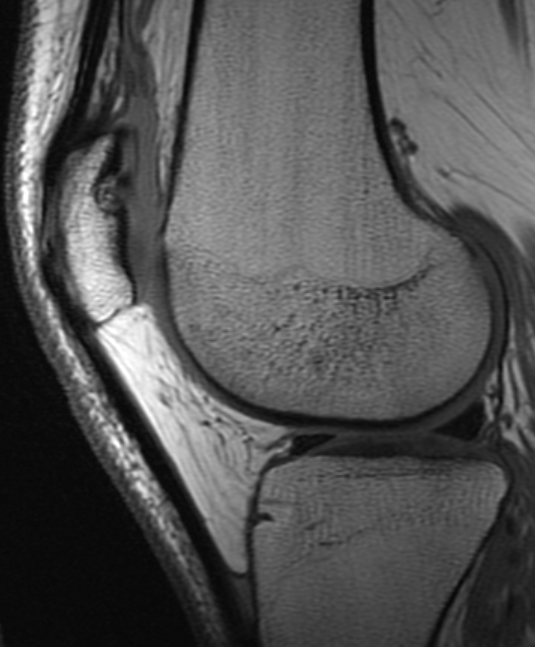 UW_MSKrad's tweet photo. #CaseOfTheWeek ‼️🎉‼️

☢️🩻☠️Case #13☠️🩻☢️
 
Another knee coming your way! 
#KneePain🦴🩻🤕

➡️➡️➡️Diagnosis❓🧐🔍🧩

#MSKRad #FOAMrad #radres #MedEd #RadEd #OrthoTwitter #SportsOrtho @ssr_rwg @UWRadRes @AOSSM_SportsMed https://t.co/MPucHPzFPb