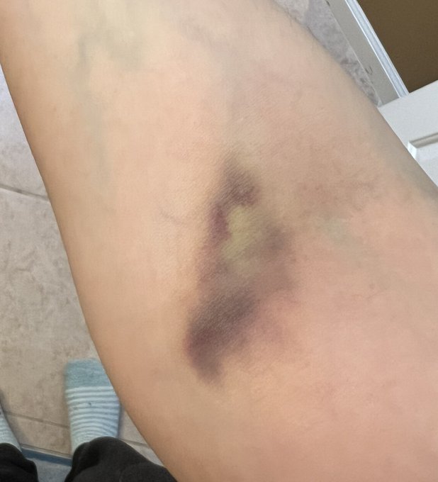 It&rsquo;s been ONE WEEK already since my procedure and look at how badly they fucked up giving me an IV. I&rsquo;ve
