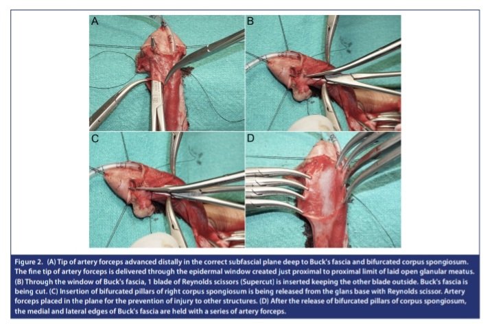 TurkJUrol's tweet photo. Surgical Technique of Glans Wings Creation with Preservation of Glanular Vascular Arcade and Creating Flaps for Tension-Free Glansplasty in Hypospadias Repair 

Archika Gupta et al. 

#glansplasty #hypospadias #PubMed #UroSoMe  #MedTwitter 
#openaccess 

https://t.co/dhcUTugFC1 https://t.co/fX38Cv3KUQ