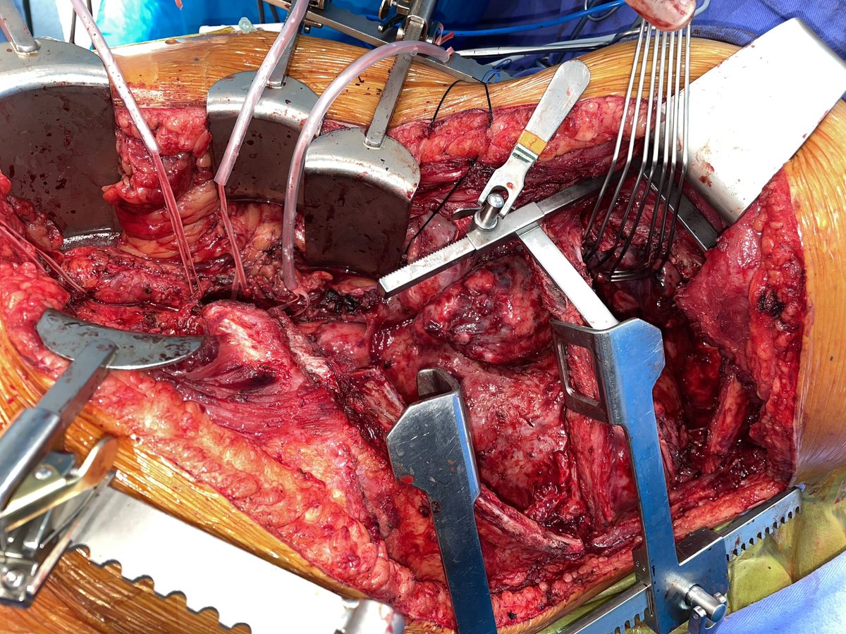 senosiain88's tweet photo. TAAA Extent II Repair. Previous type B aortic dissection with Debranching of aortic arch and TEVAR. Enourmous hematoma in the descending aorta 9.5cm https://t.co/TlW9eTswhP
