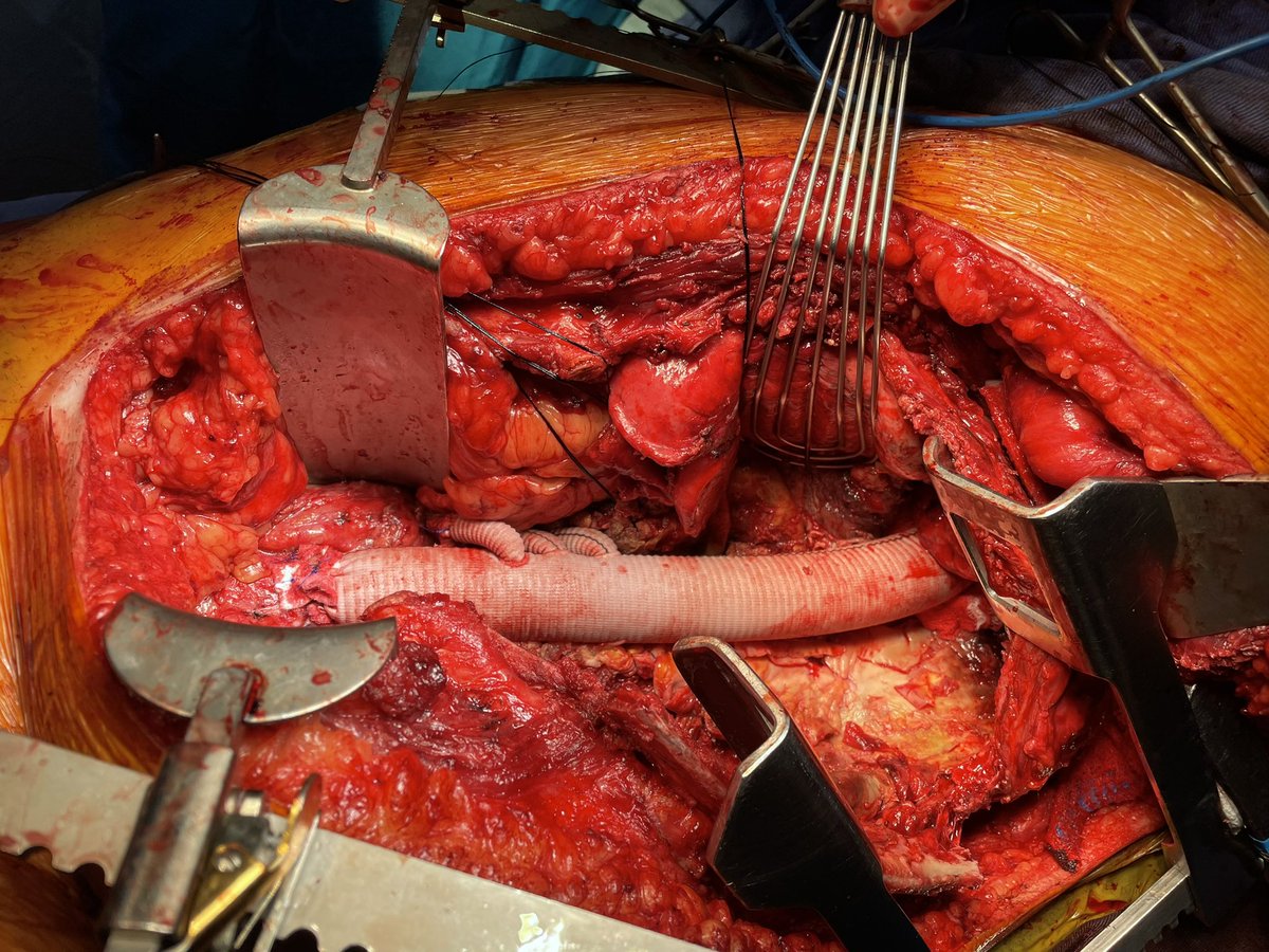 senosiain88's tweet photo. TAAA Extent II Repair. Previous type B aortic dissection with Debranching of aortic arch and TEVAR. Enourmous hematoma in the descending aorta 9.5cm https://t.co/TlW9eTswhP
