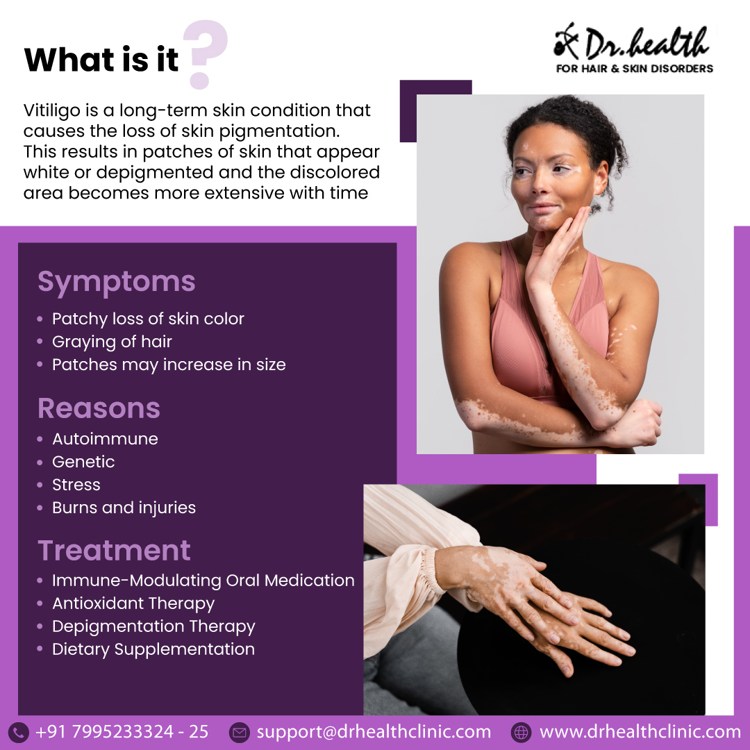 DrHealthClinics's tweet image. If you notice white patches it's important to take help from a dermatologist who can help diagnose vitiligo and provide treatment options to manage symptoms and improve the appearance of your skin.

Reach Us: drhealthclinic.com/vitiligo-treat…

#leucodermatreatment #whitepatches #vitiligo