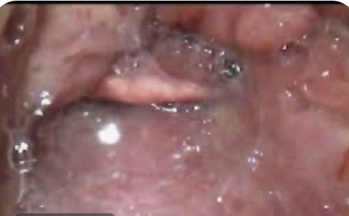 Hans Huitink (@airwaymxacademy) on Twitter photo 🎯Keep your 👁️ 👁️ on the target during (video) laryngoscopy. If you are distracted, for example to look for tracheal tube or bougie, you may ruin your best (and only?) chance because you will probably move your left arm…#eyesontarget #foamed #meded #foamcc #airway #VL <a href="/jducanto/">James DuCanto, M.D.</a> 🎯Keep your 👁️ 👁️ on the target during (video) laryngoscopy. If you are distracted, for example to look for tracheal tube or bougie, you may ruin your best (and only?) chance because you will probably move your left arm…#eyesontarget #foamed #meded #foamcc #airway #VL <a href="/jducanto/">James DuCanto, M.D.</a>