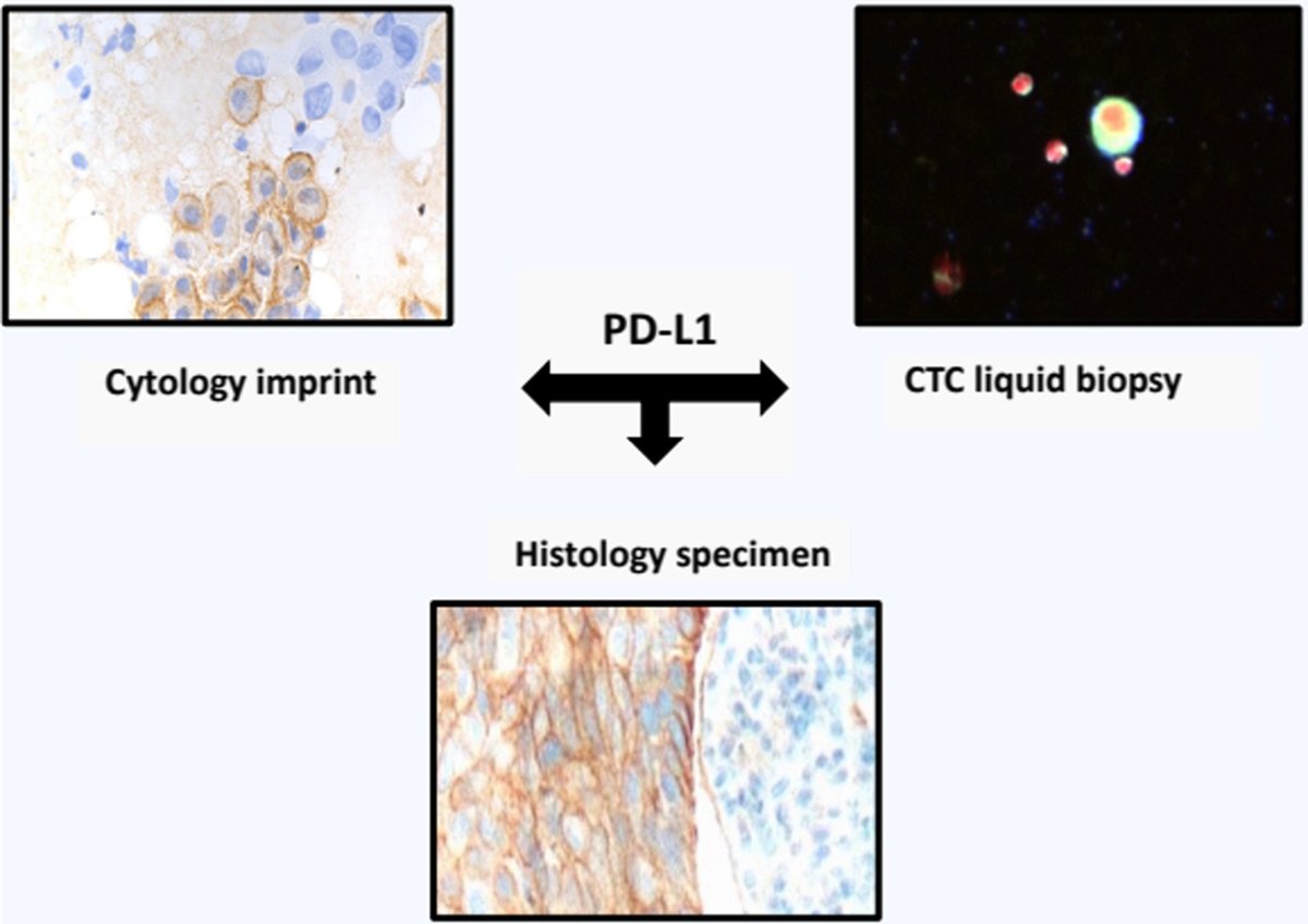 MolOncology's tweet photo. Comparative evaluation of PD-L1 expression in cytology imprints, circulating tumour cells and tumour tissue in non-small cell lung cancer patients
🔗https://t.co/KlhYrWo8jM
#CirculatingTumourCells
#LCSM #PDL1 #NSCLC https://t.co/niNZWIsOSl