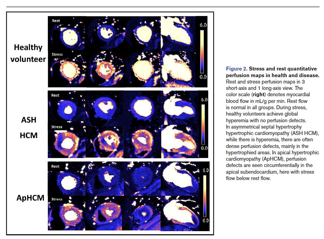 MondaEmanuele's tweet photo. Apical Ischemia Is a Universal Feature of Apical
Hypertrophic Cardiomyopathy

@CircImaging 

https://t.co/kjCQ2bbmMq https://t.co/Do6XnBDqFO