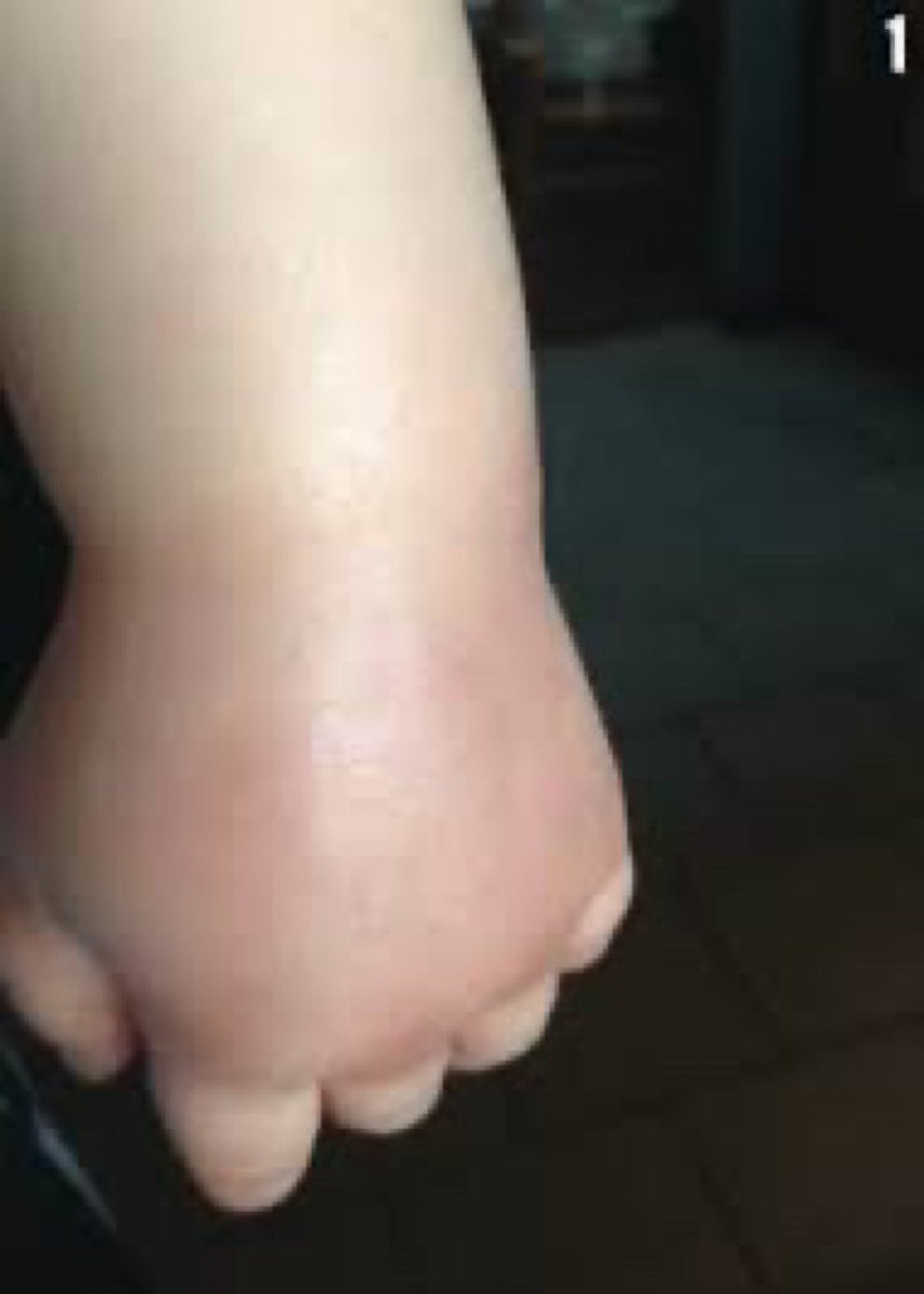 BrownJHM's tweet photo. A 10-year-old girl with hx of epilepsy on valproate came after sustaining a fall on the playground. Hx of polyuria &amp; polydipsia +. Exam w/left wrist swelling. Labs w/ hypokalemia, hypocalcemia, hypophosphatemia, and a mild metabolic acidosis. What is the likely diagnosis? #MedEd https://t.co/QE92uBTjIf