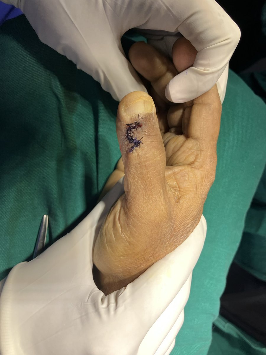 Mucous cyst of the thumb excised and covered with a rhomboid flap.