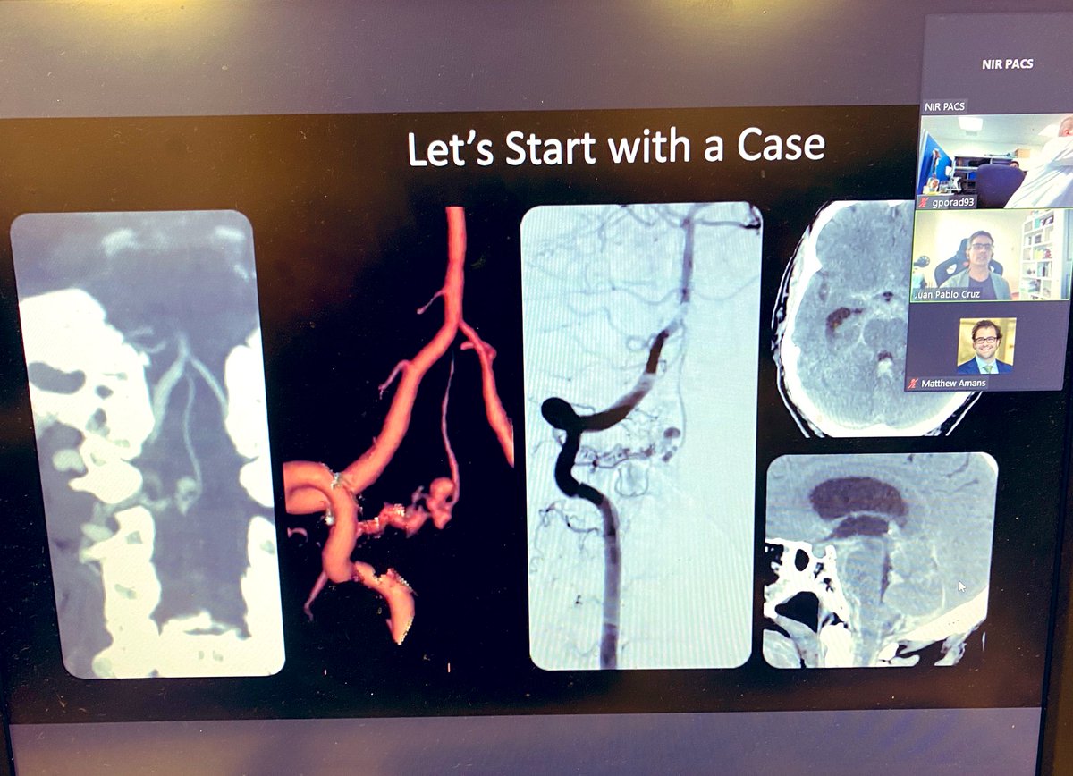 Thank you Dr. Juan Pablo Cruz @jpcruz81 for discussing interesting vascular spine lesions and approach to diagnosis and treatment during our UCSF NIR Professor Rounds! @EricRSmithMD @RaghavMattay @MattAmansMD @DrKazNIR @DowdCf
