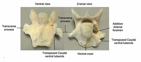 ECVM - research is finding it's not just C6 &amp; C7 that is affected.  Ribs &amp; lumbar vertebrae can have malformations too.