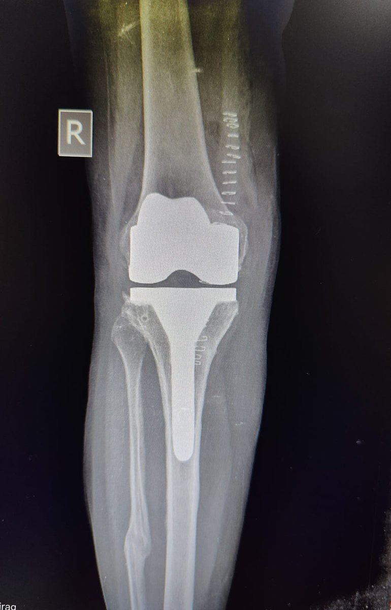 silvertouchhos1's tweet photo. Now latest in knee replacement at Silver Touch.

Gold knee implants with gold rod 

Very useful in allergic patient to metals 

Best Doctors, Affordable Treatment

Silver touch.

Committed to care

#kneereplacement #silvertouch #silvertouchhospital #goldkneeimplants #goldrod https://t.co/wNAACEhOvn
