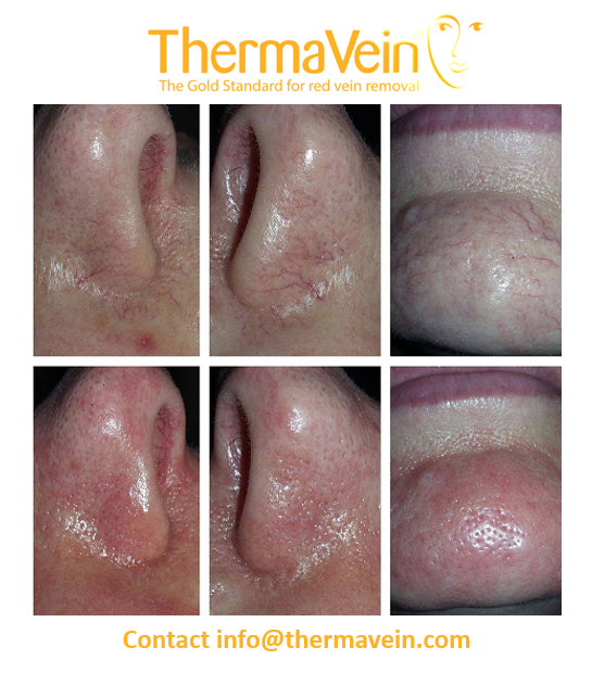 thermavein's tweet photo. Before and immediately after ThermaVein treatment. The safe, instant and effective treatment for Telangiectasia aka Spider veins.
March sale still on!
Contact us at: info@thermavein.com
#thermavein #threadveins #spiderveins #redveins #veins #beauty #aesthetics #IPL #laser https://t.co/S01KBz2HBl