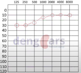 dengears_'s tweet photo. Rising konfigürasyonu, alçak frekanslarda işitme kaybı olup, yüksek frekanslarda normal işitme olmasıdır.

#hearing #hearingloss #audiology #audiologist #işitme #işitmekaybı #odyoloji https://t.co/aUI36XVtu1