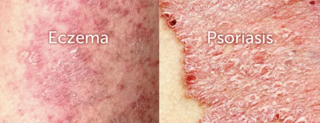 Top 10 shower gel/wash for eczema &amp; psoriasis. 

Itchy &amp; dry skin peeps, this thread is for you: