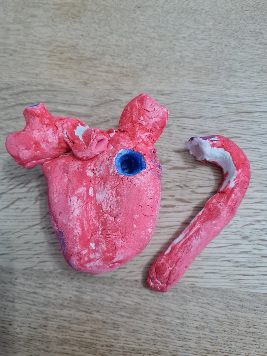 Opps the aorta snapped off...@TerumoAortic anything you can do to help? I know you specialise in products to fix aortas, the clay may be a hindrance! 😅 @AorticDissectUK @aortabuddiesuki @THINK__AORTA #ThinkAorta #ThinkAortaThinkFamily #aorticdissection #aortaed #aortabuddies