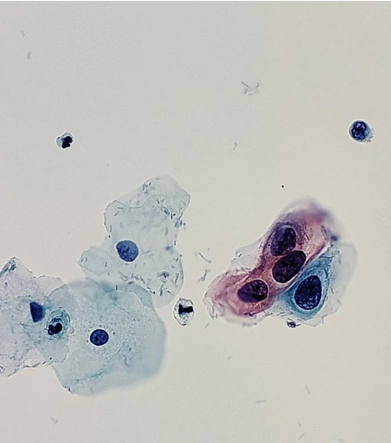 erisadoc's tweet photo. 31-year old female Pap Cervical Smear.
Normal squamous cells vs Atypical squamous cells #pathology #cytology https://t.co/rvIqeN2F3H