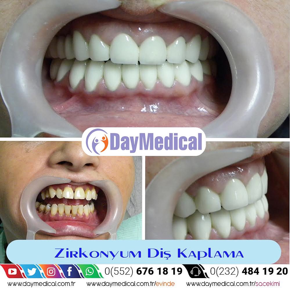 🦷Zirkonyum Diş Kaplama

Dt. Ahmet KARAGÖZ
 Randevu ve Bilgi İçin;
☎️0(232) 484 19 20
📱0(552) 676 18 19

#zirconium #zirconiumcrowns #цирконий #протезированиезубов #протезирование #zirkonyumdiş #zirkonyum #zirkonyumkaplama #zirkonyumdişkaplama #zirkonyumdis