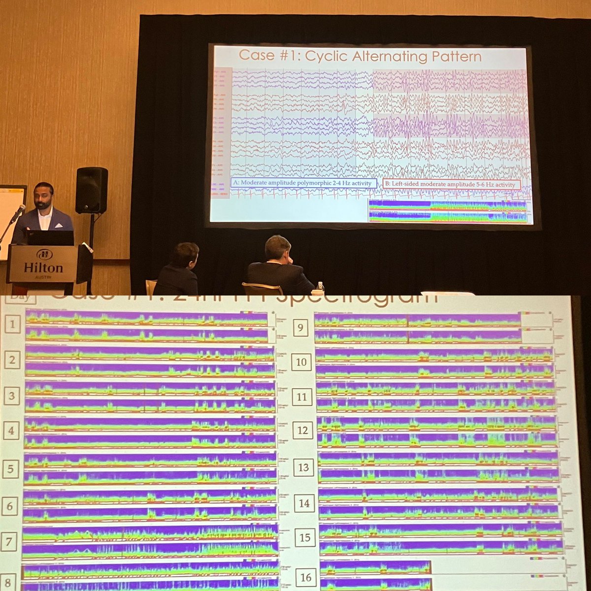 Dr. Ajay Thomas moving the field forward describing cyclic alternating pattern of encephalopathy in children with new-onset seizures and encephalopathy (best seen utilizing qEEG). One anti-NMDARE, one FIRES. Grateful for curious minds exploring the significance of these patterns!