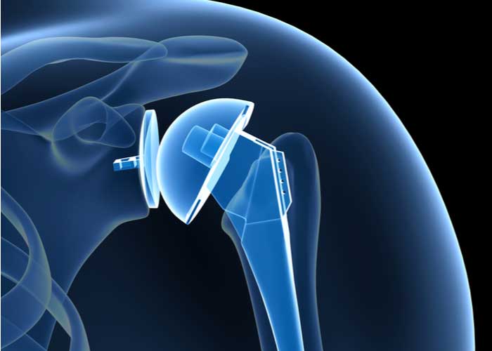drprovencher's tweet photo. When should a revision shoulder arthroplasty be considered?

· #Infection
· #Jointstability
· Joint loosening
· Shoulder prosthesis condition
· #Rotatorcuff condition
https://t.co/rrrmAs5jsH  #shouldersurgery #sportsmedicine https://t.co/tnwWKdppkP