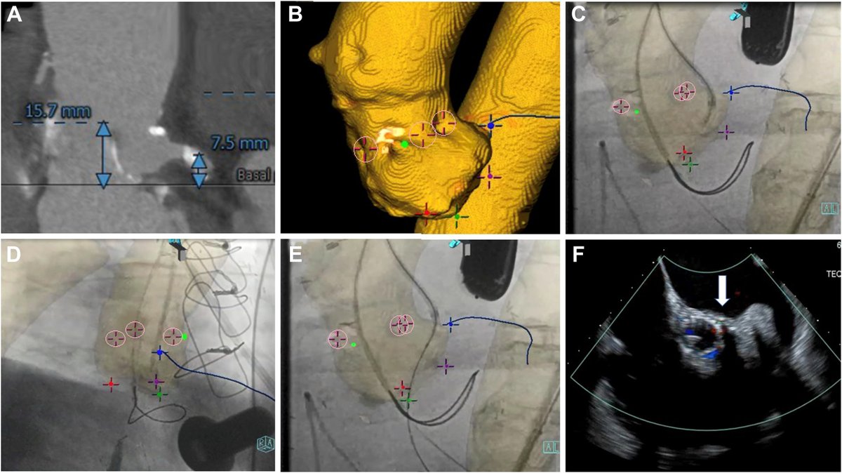 MyJSCAI's tweet image. CASE: degenerated stentless valve CT #FusionImaging to guide #BASILICA for VIV #TAVR #StructuralHeart 

➡️ doi.org/10.1016/j.jsca…

@CraigBasman  @chadkligermd @GiorgioMedranda @jeffreygeske