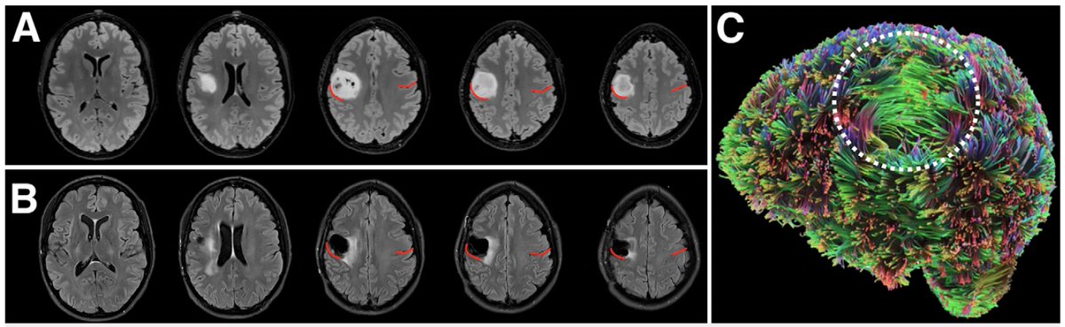 deb_f_levy's tweet image. Last year, I met a woman who&apos;d just had a left pre-central tumor removed. She&apos;s brilliant, kind, and an excellent communicator—but with some curious difficulties mapping sounds onto movements and letters onto sounds. Interested? See new case study in JNS: thejns.org/caselessons/vi…