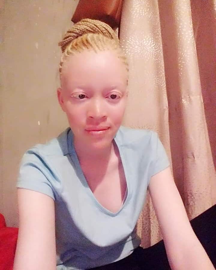 Good evening, no makeup @tee_marve 
#AlbinismKonect
#Inclusion4equality
#EndDiscrimination
#EndKillingsofPWA