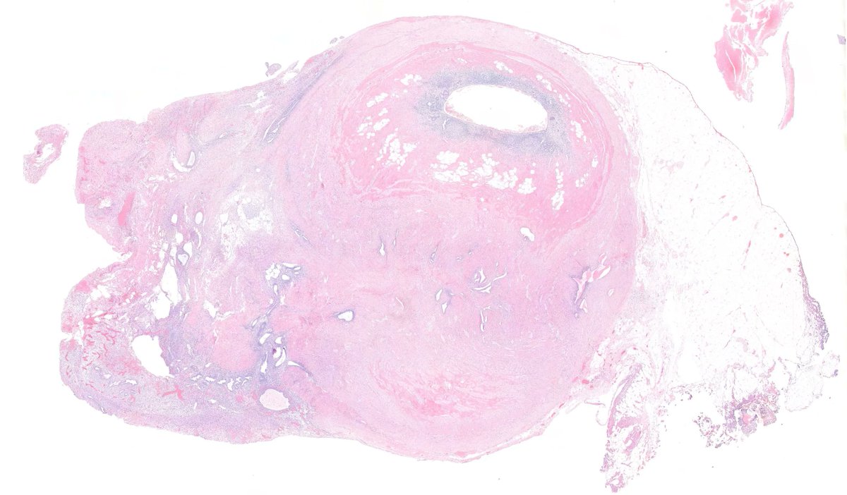 zucchiatti_'s tweet image. Appendiceal endometriosis. 
Typically incidental but can cause pain, obstruction or diarrhea. #GIpath