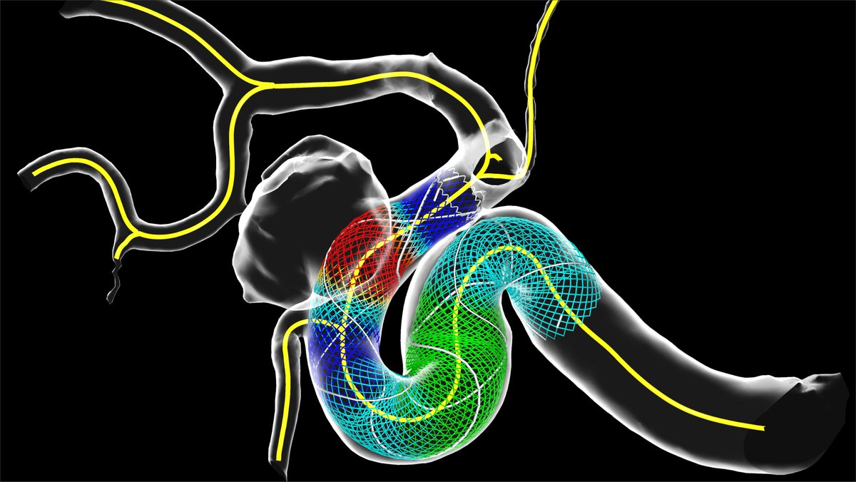 OxfordHeartbeat's tweet photo. No 2 patients or surgeries are the same.
Choosing neurovascular #surgery implants is challenging. Sub-optimal choice can lead to e.g. stroke.
#PreSize puts patients & clinicians at the ❤️ of #healthinnovation → https://t.co/1W2k2teZRf
#BrainInjuryAwareness @BAFOUND @SameYouOrg https://t.co/7g9FsijqIe