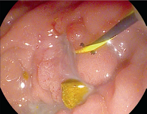 DrATEFAHMED's tweet image. Acute #cholangitis. #Endoscopic view shows spontaneous #pus outflow from the major #papilla together with #biliary #stones