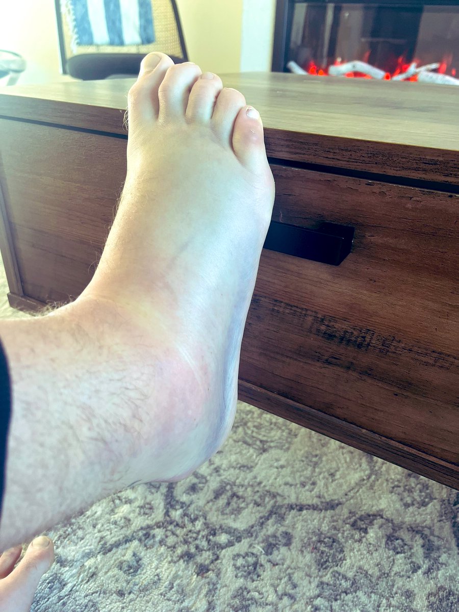 Anyone into swollen feet? 5$ a pic