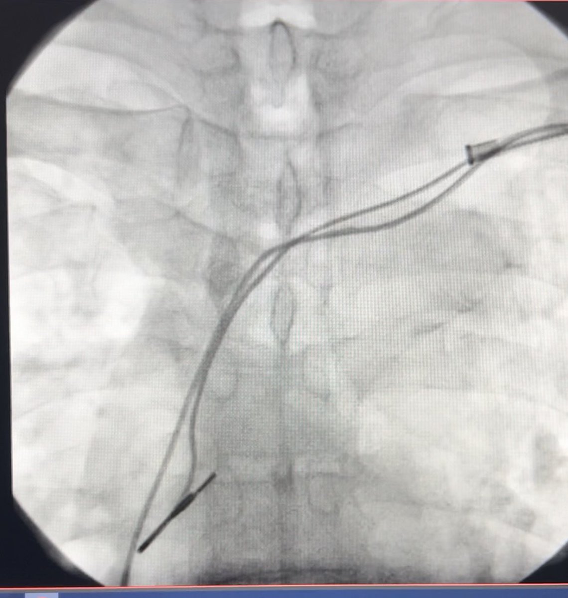 mertilkerh's tweet photo. 10 year-old CRT-D system (passive RV- dual coil, passive RA lead and LV lead) was extracted due to infection. Locking stylets and  11F cook were used. #CardioTwitter #EPeeps #pacemaker #CRTD https://t.co/NcDdR1JIbh