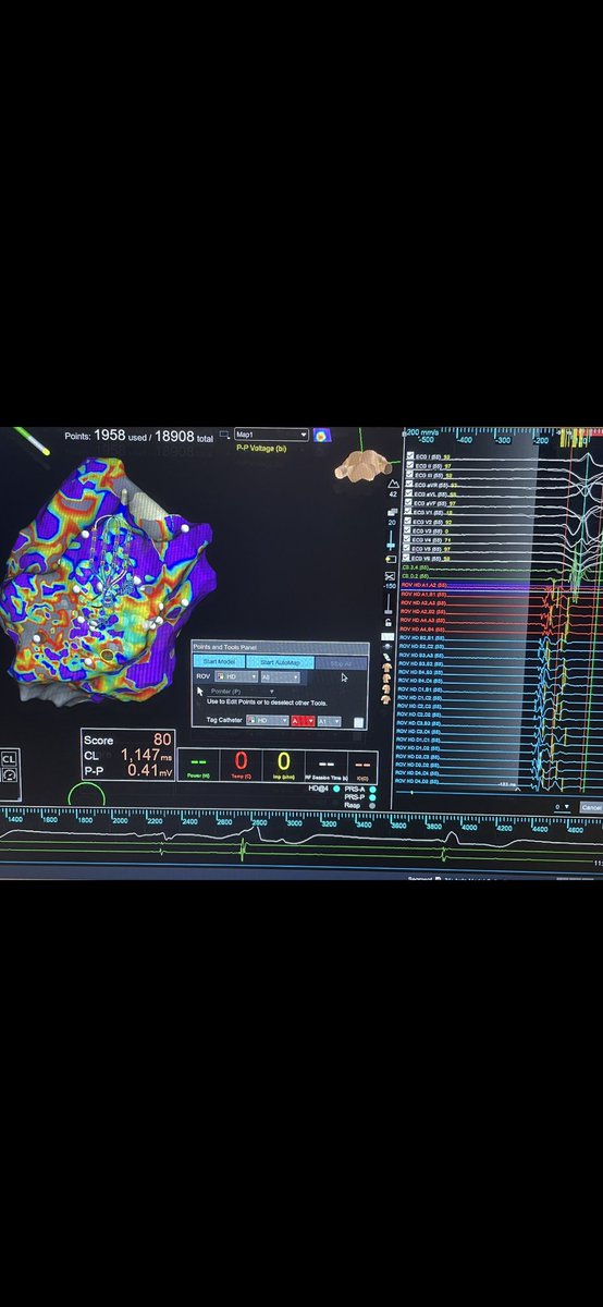 rfablation's tweet photo. #EPeeps First #EnsiteX procedure in Liguria at Lavagna Hospital. LAVA easy map #HDGrid guided in inferobasal LV. #TactiCath quickly effective @messapus @PaoloDellaBell1 https://t.co/MjrLZSVTCc