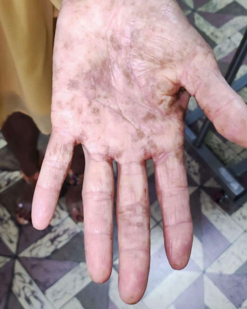 Cpperez2010's tweet photo. #LESIONES #CUTANEAS sugestivas de #VASCULITIS #AUTOINMUNE, en tiempos de Post Pandemia! https://t.co/NCmqlsy7k1