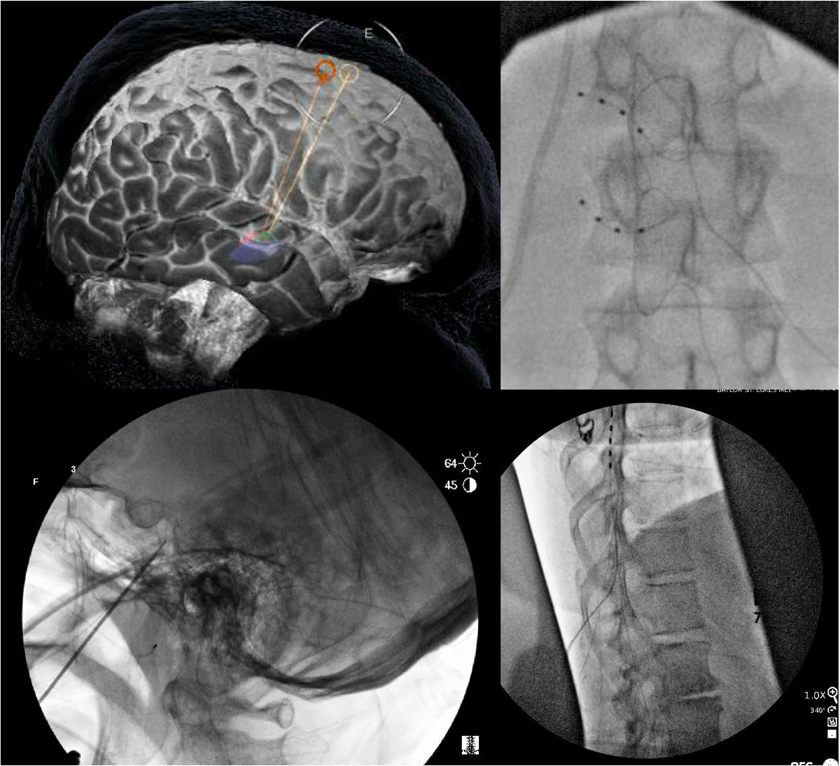 A day in the life of a #functional #neurosurgeon.  #DBS for #ParkinsonDisease, #DRG for #CRPS, #trigeminal gangliolysis for #MultipleSclerosis related #trigeminalneuralgia and #intrathecal drug delivery for #cancerpain. Great job by @risnyder14, @goetheeric1, and GBanks!