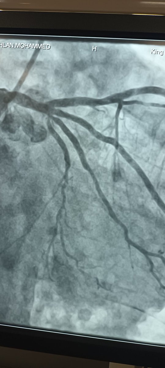 Today, we did several cases of heavily calcified lesions. I used the Diamondback 360 Coronary Orbital Atherectomy System’s and new #Medtronic Onyx Frontier DES. Excellent atherectomy device and excellent stent. Love 💚 it.