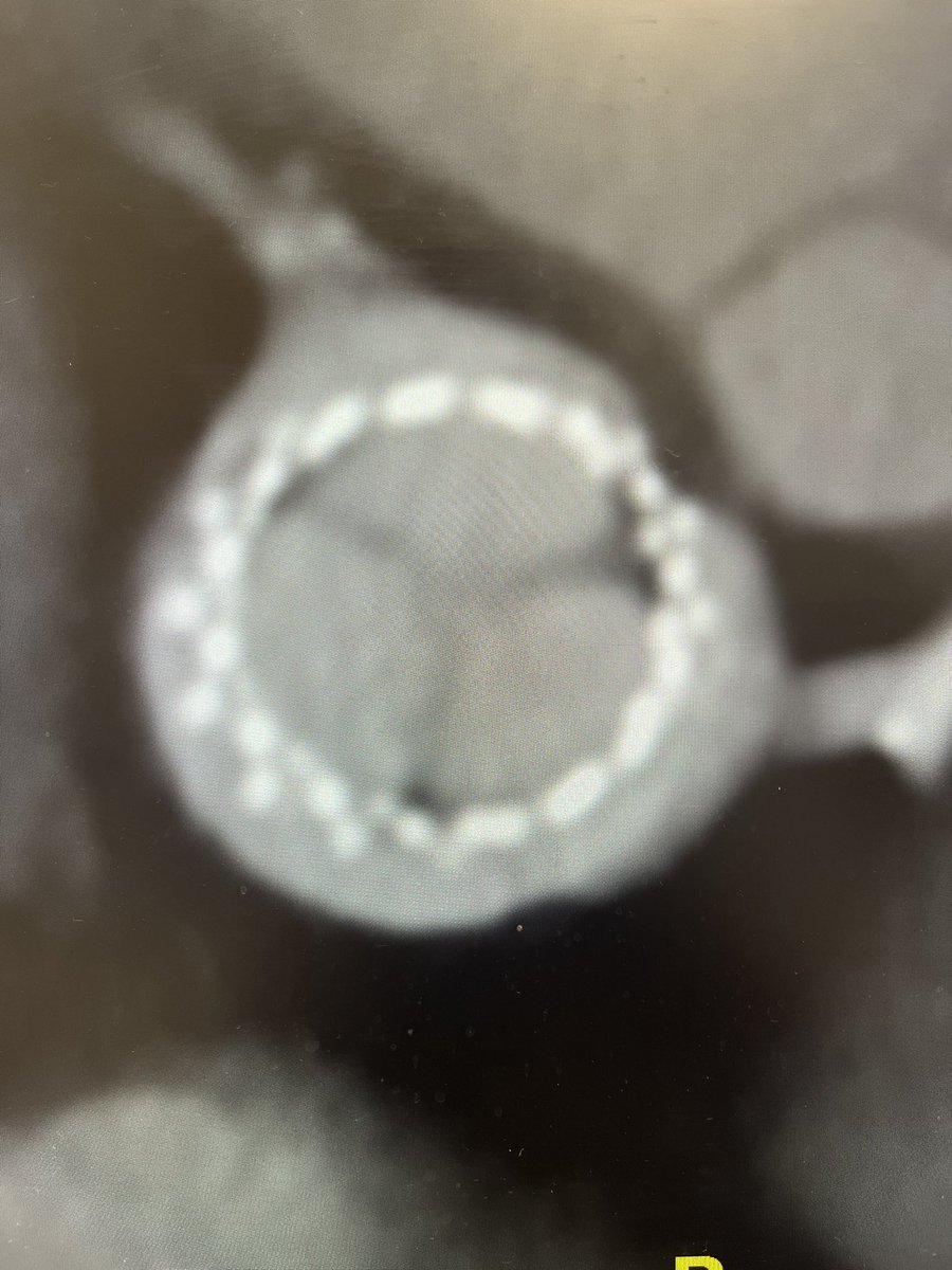 GonzalezLenguMD's tweet photo. Real life example of a good commissural alignment, CTA showed excellent alignment that was confirmed with easy coronary access during cath. Thank you @GilbertTangMD  for teaching us it was possible. @CCIndianRiver @TAVRBot @MDT_Cardiac @PopmaJeffrey https://t.co/aXWIBH8APF