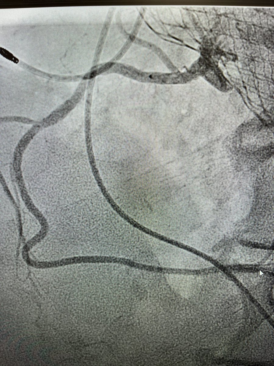 Carlos A Gonzalez L (@gonzalezlengumd) on Twitter photo Real life example of a good commissural alignment, CTA showed excellent alignment that was confirmed with easy coronary access during cath. Thank you <a href="/GilbertTangMD/">Dr. Gilbert Tang</a> for teaching us it was possible. <a href="/CCIndianRiver/">Cleveland Clinic Indian River Hospital</a> <a href="/TAVRBot/">TAVR Bot</a> <a href="/MDT_Cardiac/">Medtronic Cardiac</a> <a href="/PopmaJeffrey/">Jeffrey Popma</a> Real life example of a good commissural alignment, CTA showed excellent alignment that was confirmed with easy coronary access during cath. Thank you <a href="/GilbertTangMD/">Dr. Gilbert Tang</a> for teaching us it was possible. <a href="/CCIndianRiver/">Cleveland Clinic Indian River Hospital</a> <a href="/TAVRBot/">TAVR Bot</a> <a href="/MDT_Cardiac/">Medtronic Cardiac</a> <a href="/PopmaJeffrey/">Jeffrey Popma</a>