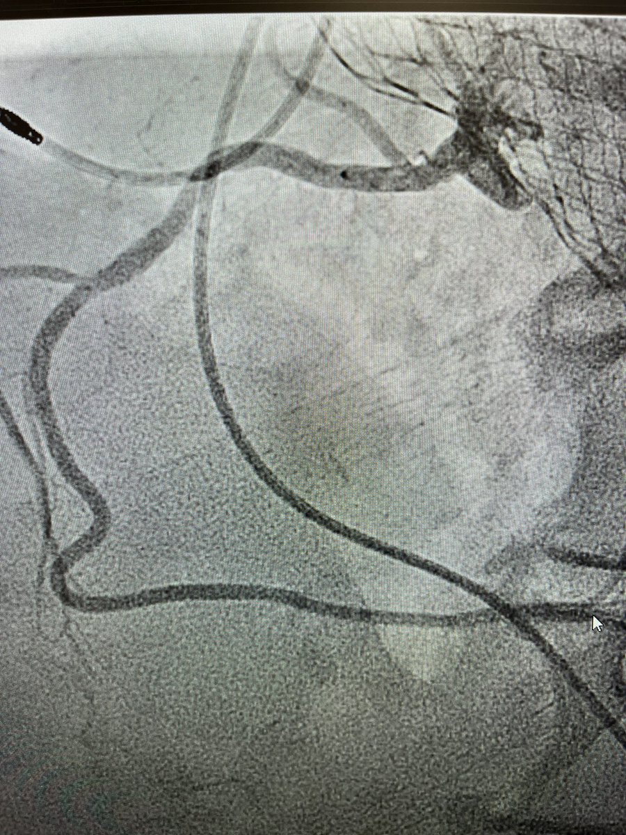 Real life example of a good commissural alignment, CTA showed excellent alignment that was confirmed with easy coronary access during cath. Thank you @GilbertTangMD for teaching us it was possible. @CCIndianRiver @TAVRBot @MDT_Cardiac @PopmaJeffrey