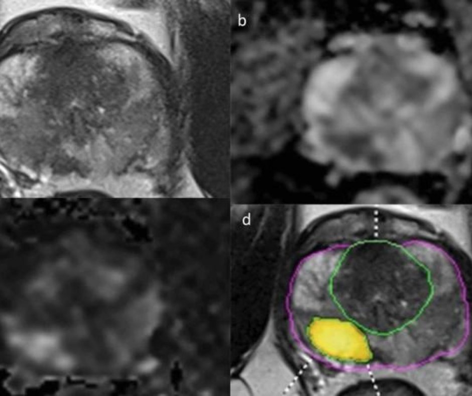 Dx_imaging's tweet photo. Study Finds No Impact for #DeepLearing Software in PI-RADS Scoring or Diagnosis of #ProstateCancer https://t.co/Xvdb4IBmmU @ACRRFS @ACRYPS @RadiologyACR @ARRS_Radiology @SocietyAbdRad @MontefioreRAD @PennRadiology @DukeRadiology @YaleRadiology @UABRadiology #radiology #RadRes https://t.co/SYoEcXU7Ry
