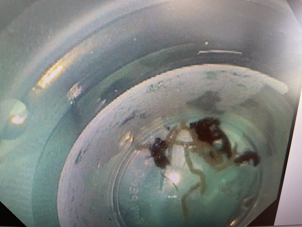 Abhilash Perisetti (Abhi) (@abhilashperise1) on Twitter photo Modified wet suction with use of a mesh device such as core catcher can increase the yield of high quality cores Modified wet suction with use of a mesh device such as core catcher can increase the yield of high quality cores