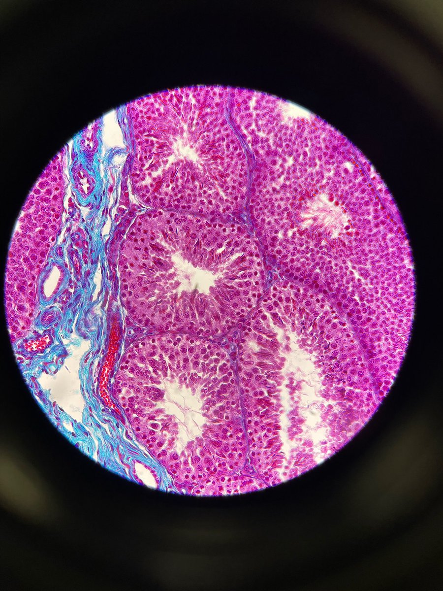 pbl_em_pratica's tweet photo. Visualização dos túbulos seminíferos no microscópio.

Fonte: @pbl_em_pratica 

#histologia #histology #MedEd #MedTwitter https://t.co/FrY0E8TyWn