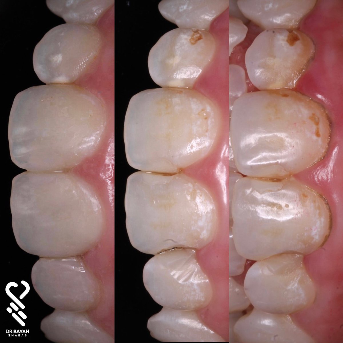 dr_ryn7's tweet photo. Minimal intervention dentistry {MID}🪄🧡
@Sensedent https://t.co/buDxzuEhDd
