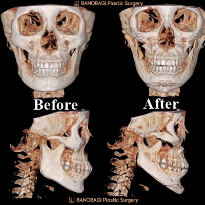 banobagithai's tweet image. Real Review 💗 ปรับโครงหน้า ตา แก้จมูก แก้ทุกปัญหากังวลใจ ตอนที่ 5

อ่านต่อเพิ่มเติมได้ที่👉banobagithai.blogspot.com/2023/03/real-r…

#banobagi #บาโนบากิ #วีไลน์ #ปรับโครงหน้า #ลดโหนก #ลดกราม #ศัลยกรรมเกาหลี #รีวิวศัลยกรรม #ปรับโครงหน้าสามจุด #เสริมจมูก