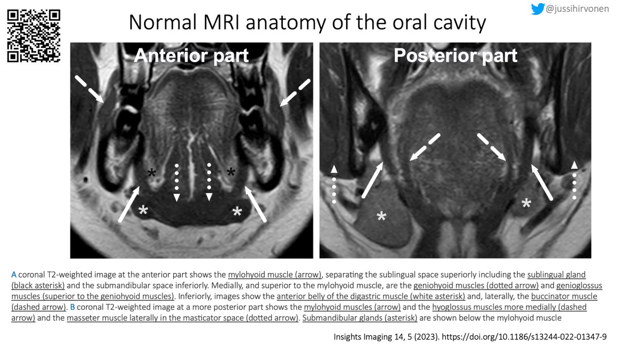 Normal MRI anatomy of the oral cavity

insightsimaging.springeropen.com/articles/10.11…

insightsimaging.springeropen.com/articles/10.10…

(2/3)