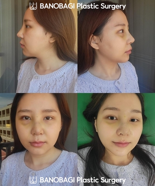 banobagithai's tweet image. Real Review 💗 ปรับโครงหน้า ตา แก้จมูก แก้ทุกปัญหากังวลใจ ตอนที่ 5

อ่านต่อเพิ่มเติมได้ที่👉banobagithai.blogspot.com/2023/03/real-r…

#banobagi #บาโนบากิ #วีไลน์ #ปรับโครงหน้า #ลดโหนก #ลดกราม #ศัลยกรรมเกาหลี #รีวิวศัลยกรรม #ปรับโครงหน้าสามจุด #เสริมจมูก