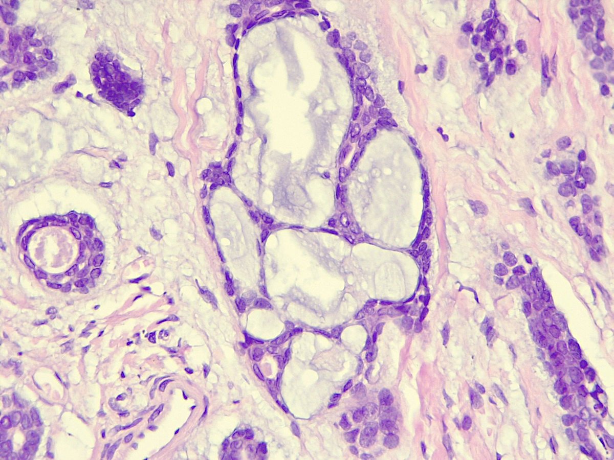 Adenoid Cystic Carcinoma of Palate.