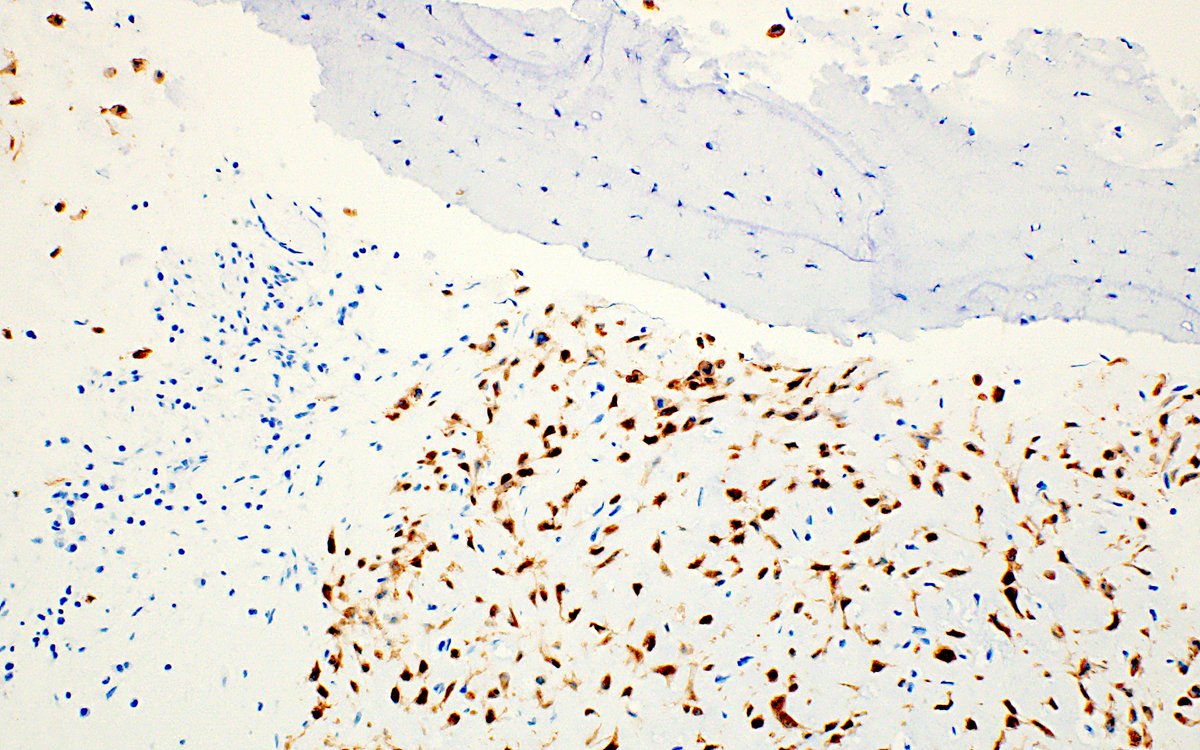 3 cm lytic lesion of the ilium: strong and diffuse GRM1 expression by IHC supports the diagnosis of chondromyxoid fibroma in this scant biopsy. #BSTpath #IHCpath