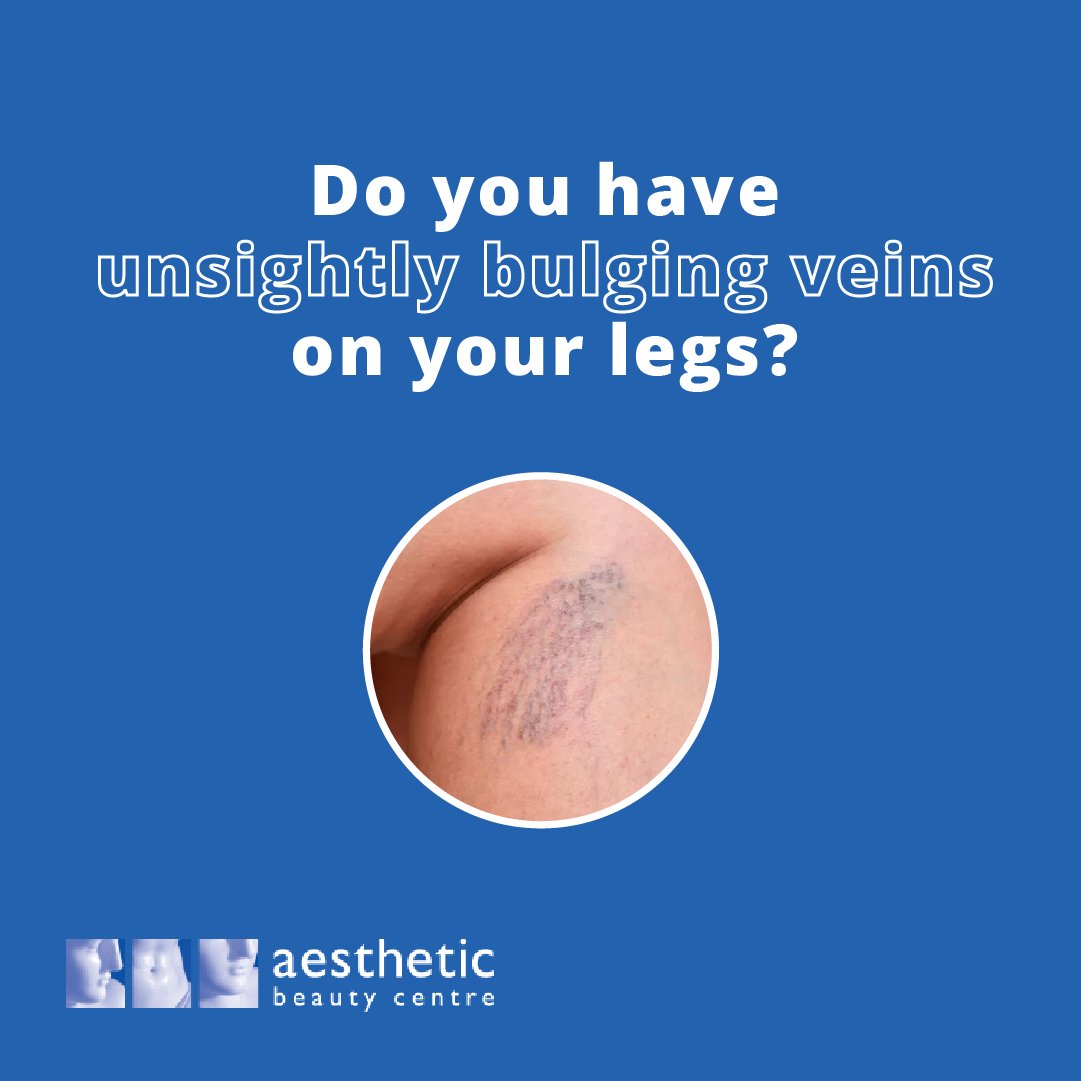 Do you have unsightly bulging veins on your legs? You may be suffering from #VaricoseVeins or #SpiderVeins. This condition affects millions of people and can cause pain or discomfort.

#Sclerotherapy or Laser Treatment is an effective treatment to get rid of unsightly veins.