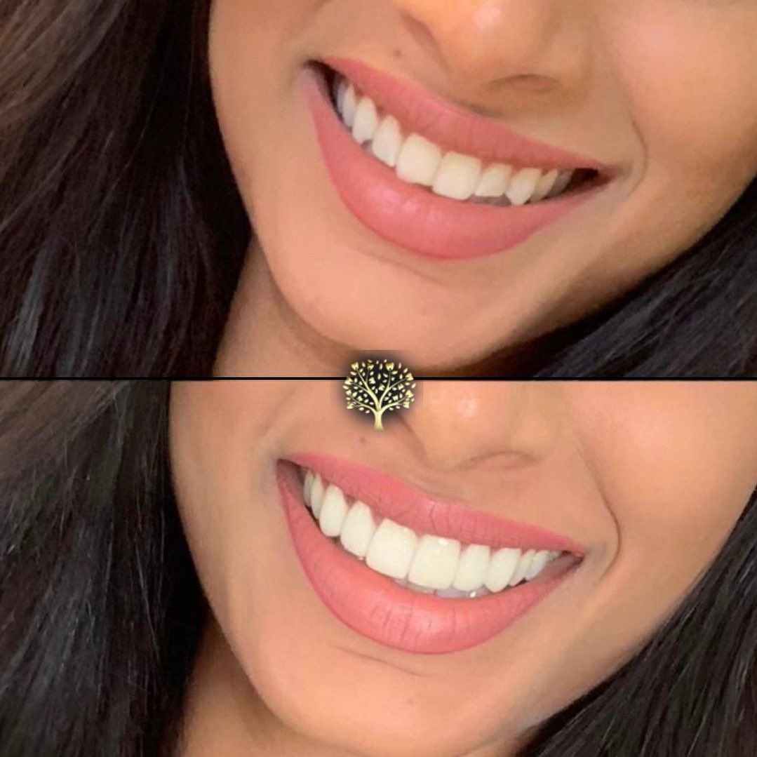 Another beautiful example of our smile transformation! 

⭐️6 Porcelain Veneers - Upper arch
⭐️ Teeth Whitening 

#beforeandafter #porcelainveneers #veneers #teethwhitening