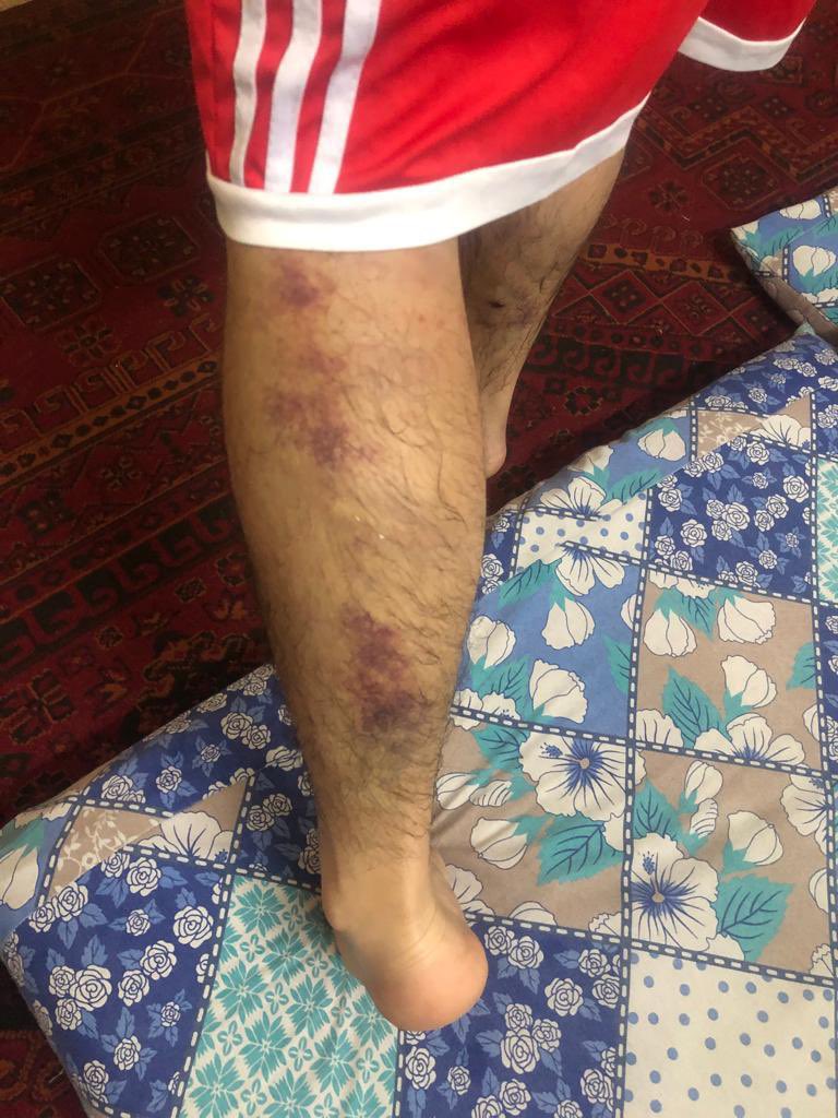 Amjad_ISF's tweet photo. Zainul Hassan an IR student from numl university an ISF member. He was arrested from Islamabad during IK’s appearance in JC. He is badly tortured. His thumb is fractured. He is out now and is saying that I will fight with more passion now. U v lost this battle. Try smthing else https://t.co/IMWUwctWxn